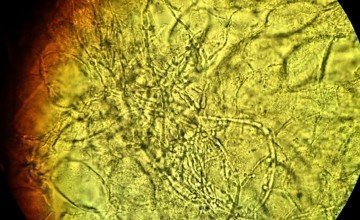 CANDIDA ALBICANS ANALYSIS